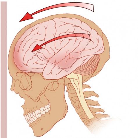 Concussion Protocols